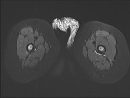 File:Neuroblastoma with bone metastases (Radiopaedia 67080-76414 Axial STIR 33).jpg