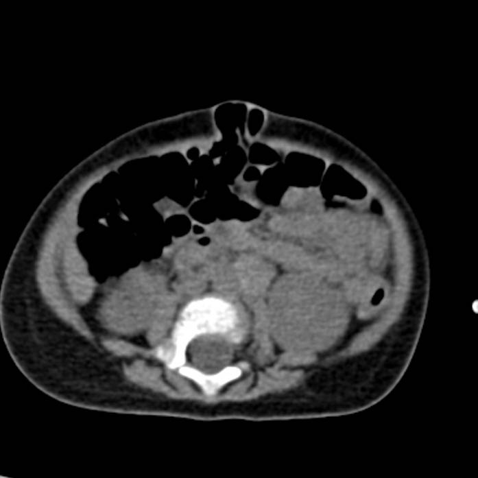 Neuroblastoma with skull metastases (Radiopaedia 30326-30960 Axial non-contrast 35).jpg