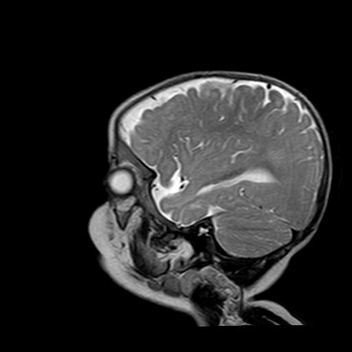 File:Neurofibromatosis type 1 (Radiopaedia 30089-30671 Sagittal T2 2).jpg
