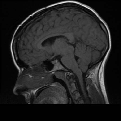 File:Neurofibromatosis type 2 (Radiopaedia 45229-49244 Sagittal T1 10).png