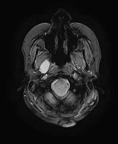 File:Neurofibromatosis type 2 (Radiopaedia 66211-75401 Axial Gradient Echo 7).jpg