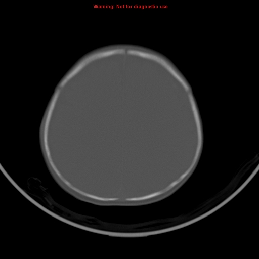 File:Non-accidental injury - bilateral subdural with acute blood (Radiopaedia 10236-10765 Axial bone window 17).jpg