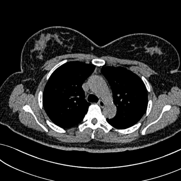 Normal CT chest- adult female (Radiopaedia 52522-58428 Axial non-contrast 45).jpg