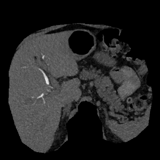 File:Normal CT intravenous cholangiogram (Radiopaedia 38199-40208 Axial IVC (MIP) 57).png