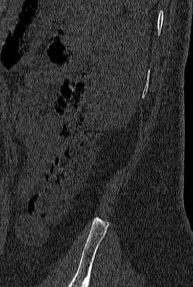 File:Normal CT lumbar spine (Radiopaedia 53981-60118 Sagittal bone window 108).jpg