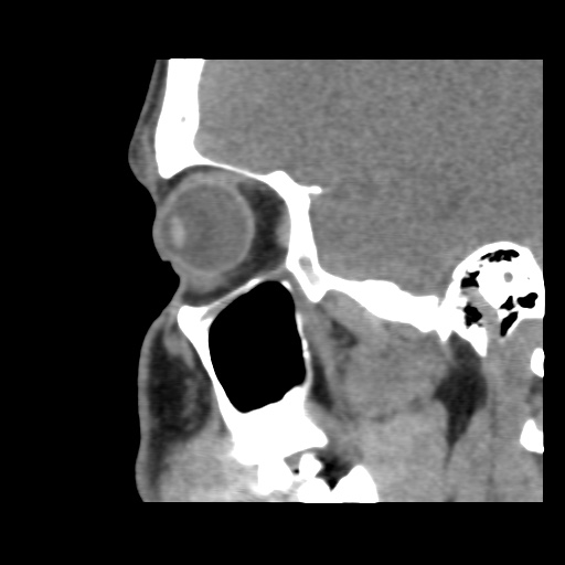 Normal CT paranasal sinuses (Radiopaedia 42286-45390 F 46).jpg