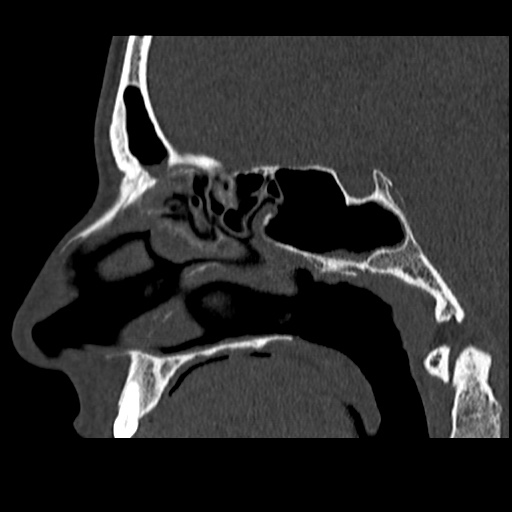Normal CT paranasal sinuses (Radiopaedia 42286-45390 Sagittal bone window 55).jpg