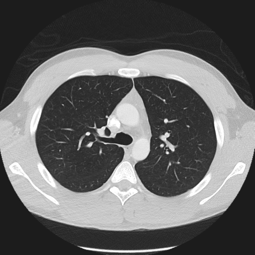 Normal CT pulmonary veins (pre RF ablation) (Radiopaedia 41748-44702 Axial lung window 5).png