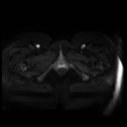 Normal MRI abdomen in pregnancy (Radiopaedia 88005-104548 Axial DWI 40).jpg