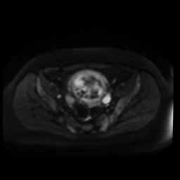 Normal MRI abdomen in pregnancy (Radiopaedia 88005-104548 Axial DWI 56).jpg