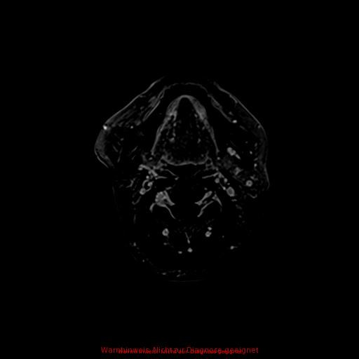 Normal adult brain MRI (non-enhanced and contrast-enhanced) (Radiopaedia 75262-86379 Axial T1 C+ 5).jpg