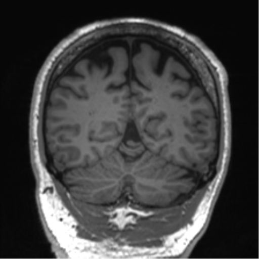 Normal brain MRI (non-focal epilepsy protocol) (Radiopaedia 53917-60040 Coronal T1 20).png