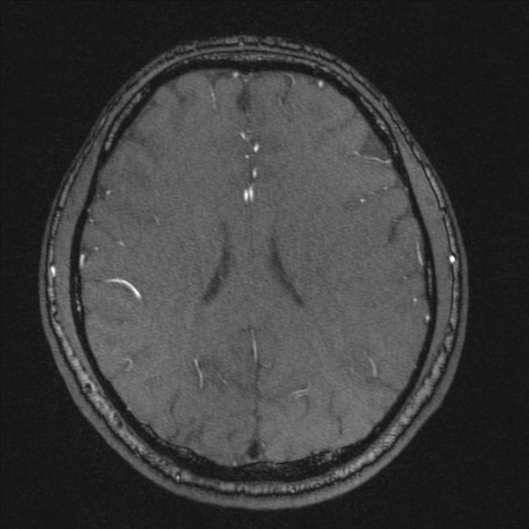 Normal brain MRI including MRA (Radiopaedia 48748-53763 Axial MRA 142).jpg
