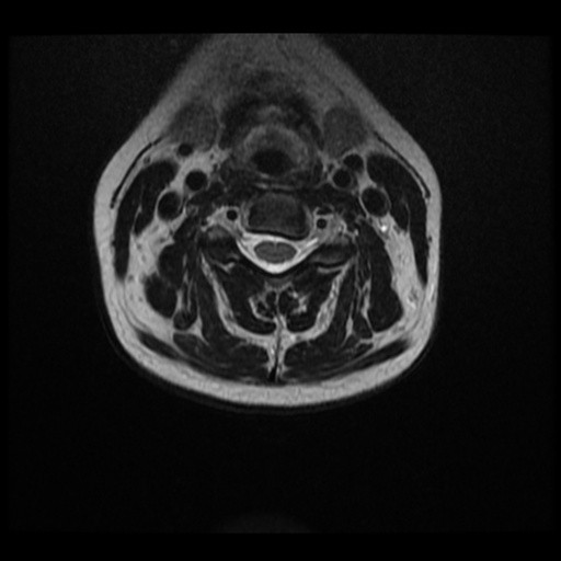 File:Normal cervical and thoracic spine MRI (Radiopaedia 35630-37156 Axial T2 20).png