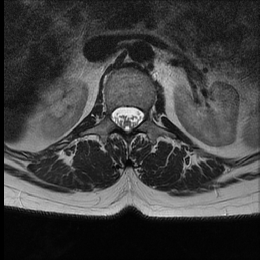 File:Normal cervical and thoracic spine MRI (Radiopaedia 35630-37156 H 4).png