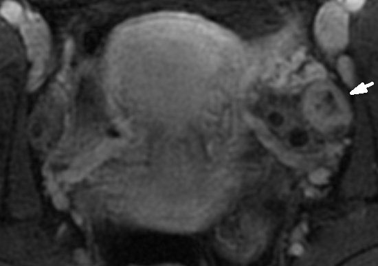 File:Normal corpus luteum on MRI (Radiopaedia 13818-13696 B 1).jpg