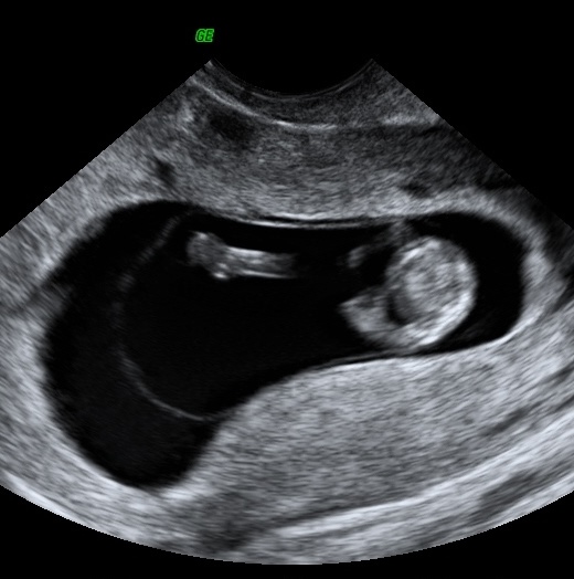 File:Normal early pregnancy with physiological gut herniation (Radiopaedia 13788).jpg