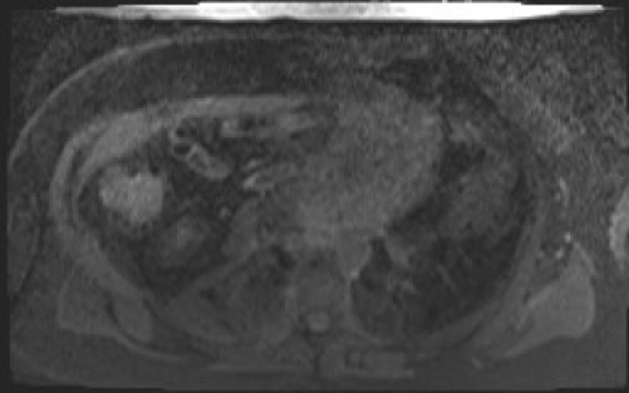 File:Normal hepatobiliary phase liver MRI (Radiopaedia 58968-66230 A 1).jpg