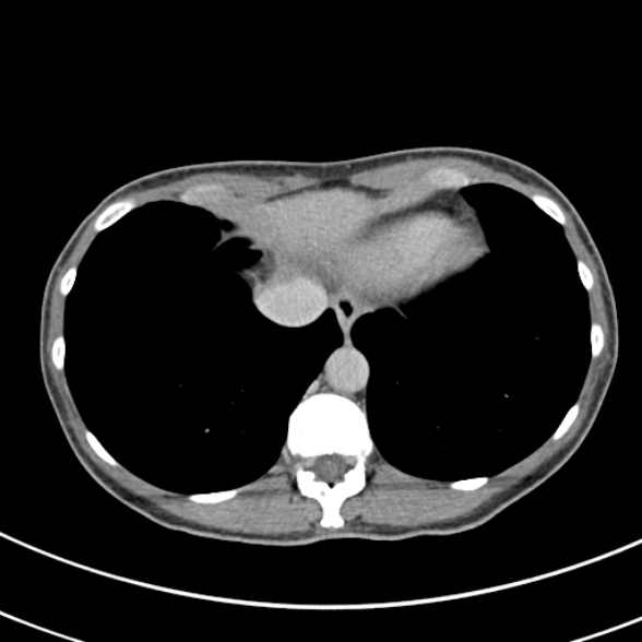 File:Normal multiphase CT liver (Radiopaedia 38026-39996 Axial C+ delayed 4).jpg