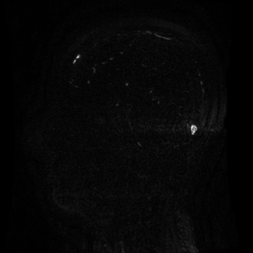 Normal noncontrast MR venography (Radiopaedia 87578-103957 A 80).jpg