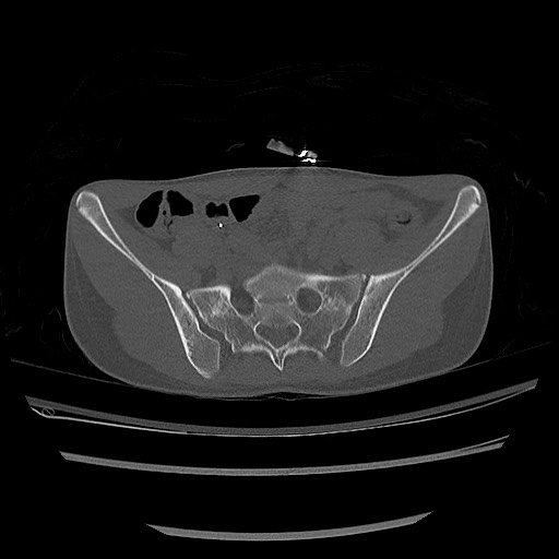 Normal pelvis CT (Radiopaedia 51471-57236 Axial bone window 30).jpg