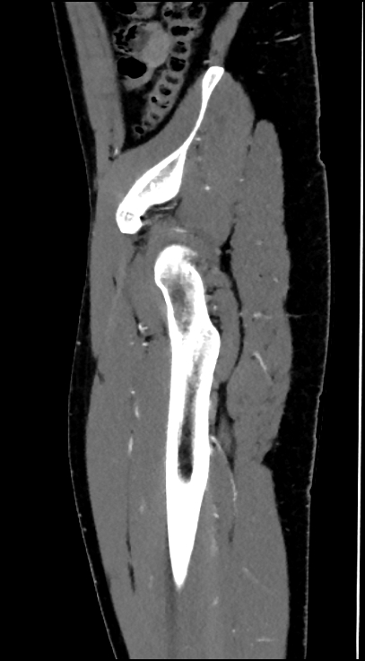 Normal pelvis CT angiogram (Radiopaedia 84966-100481 C 90).jpg