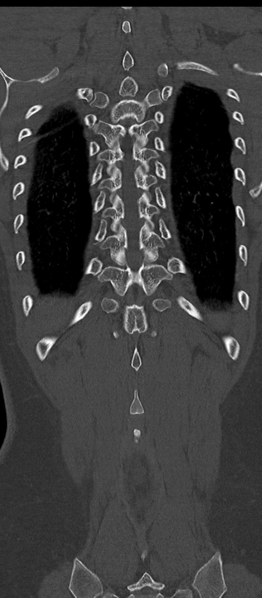Normal thoracolumbar spine (Radiopaedia 43822-47309 Coronal bone window 75).png