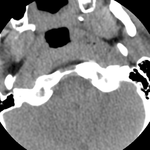 Normal trauma cervical spine (Radiopaedia 41017-43760 Axial non-contrast 8).png
