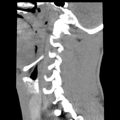 File:Normal trauma cervical spine (Radiopaedia 41017-43760 B 7).png