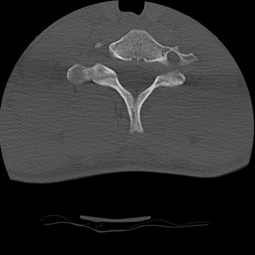 Normal trauma spine imaging (age 16) (Radiopaedia 45335-49358 Axial bone window 64).jpg