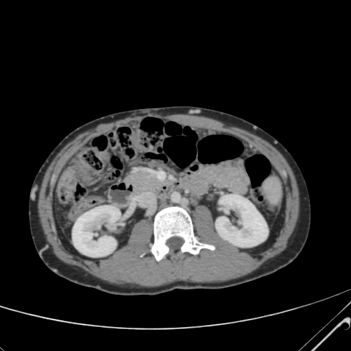 File:Nutmeg liver- Budd-Chiari syndrome (Radiopaedia 46234-50635 B 29).png