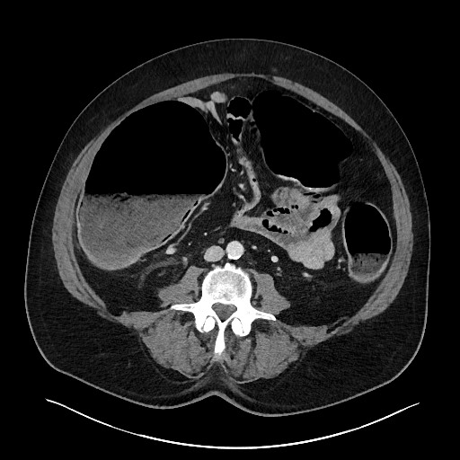 File:Obstructing sigmoid adenocarcinoma (Radiopaedia 58465-65619 A 97).jpg