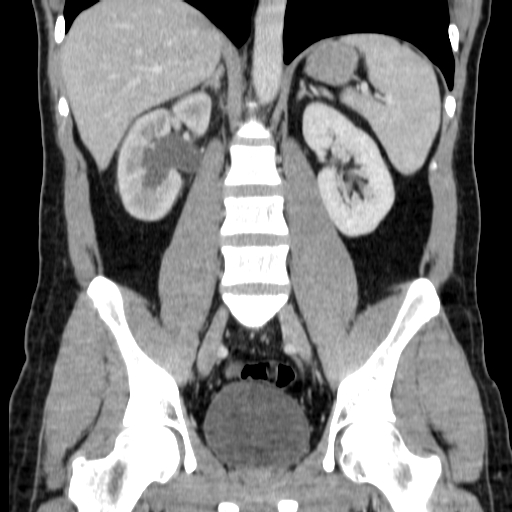File:Obstructing ureteric calculus (Radiopaedia 18615-18514 C 47).jpg