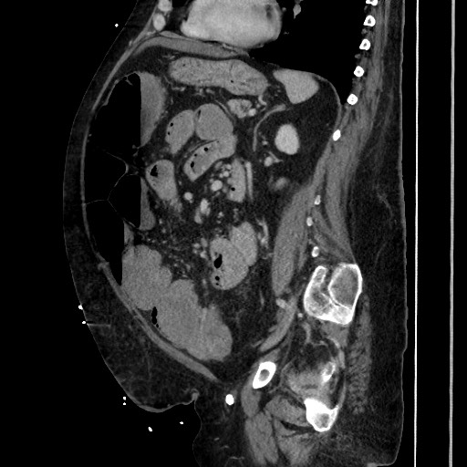Obstructive colonic diverticular stricture (Radiopaedia 81085-94675 C 147).jpg