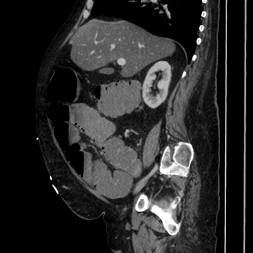 Obstructive colonic diverticular stricture (Radiopaedia 81085-94675 C 96).jpg