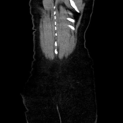 Obstructive distal colonic adenocarcinoma causing cecal perforation (Radiopaedia 86830-102989 C 155).jpg