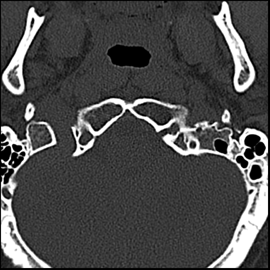 Occipital condyle fracture (type 1) (Radiopaedia 87670-104084 Axial bone window 6).jpg