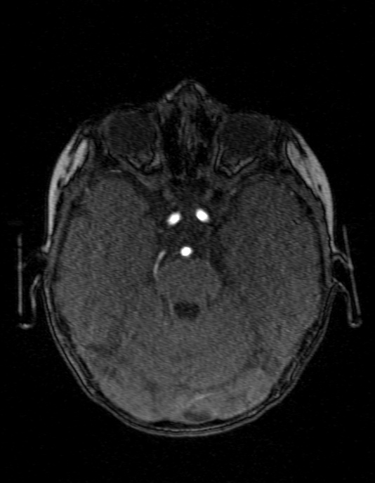Occipital horn syndrome (Radiopaedia 14255-14129 MRA 51).jpg