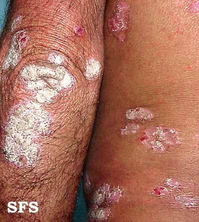 File:Psoriasis (Dermatology Atlas 17).jpg