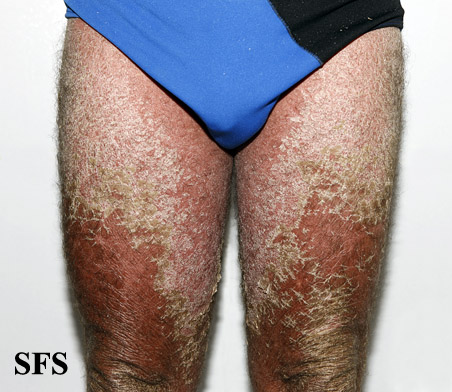 File:Psoriasis (Dermatology Atlas 68).jpg