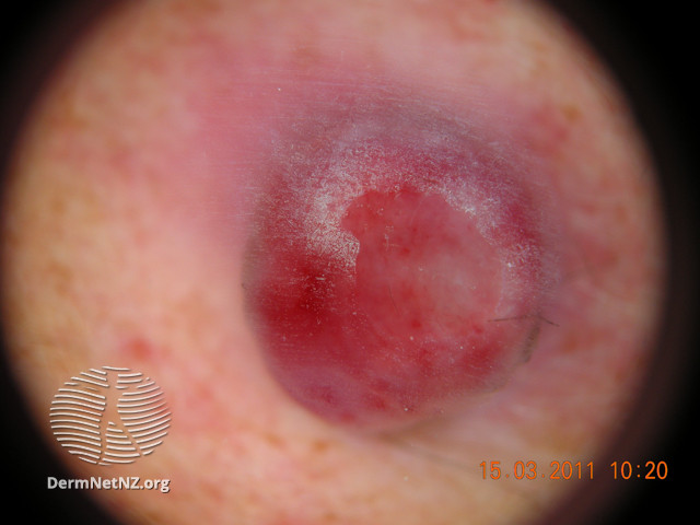 File:Pyogenic granuloma (DermNet NZ pyogenic-granuloma-1001).jpg