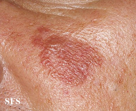 File:Sarcoidosis (Dermatology Atlas 17).jpg