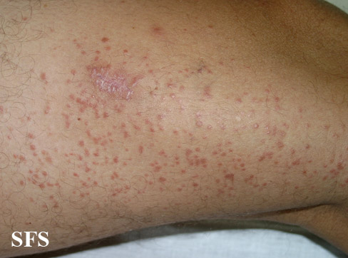 File:Syringoma (Dermatology Atlas 17).jpg