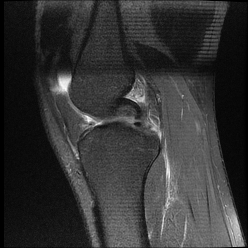 File:ACL acute full thickness tear - deep lateral femoral sulcus sign (Radiopaedia 38594-40740 Sagittal PD fat sat 9).jpg