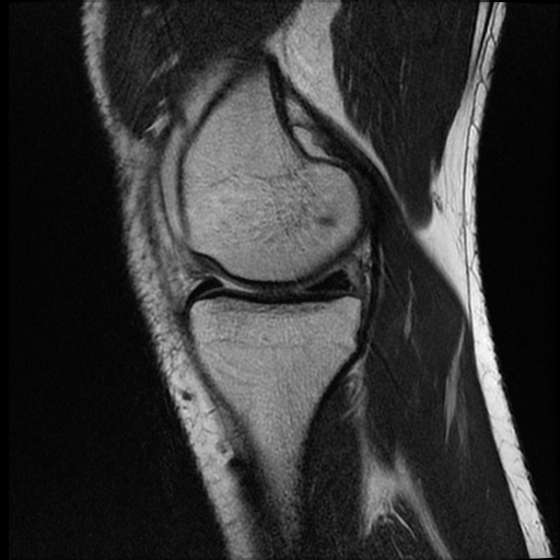 File:ACL acute full thickness tear - deep lateral femoral sulcus sign (Radiopaedia 38594-40740 Sagittal T2 6).jpg