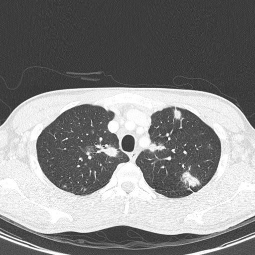 AIDS-related Kaposi sarcoma (Radiopaedia 85247-100811 Axial lung window 36).jpg