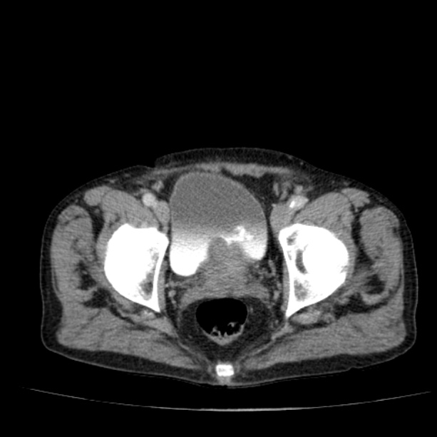 Abdominal aortic aneurysm (Radiopaedia 29248-29660 Axial C+ portal venous phase 57).jpg