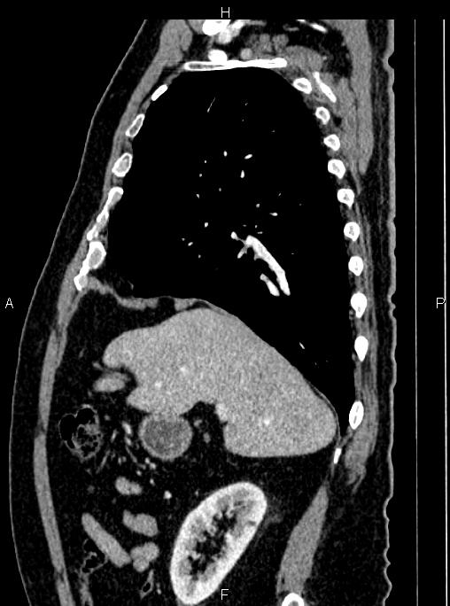 Abdominal aortic aneurysm (Radiopaedia 83094-97462 Sagittal renal cortical phase 41).jpg