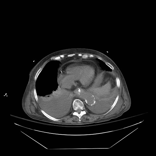 Abdominal aortic aneurysm - impending rupture (Radiopaedia 19233-19247 Axial non-contrast 25).jpg