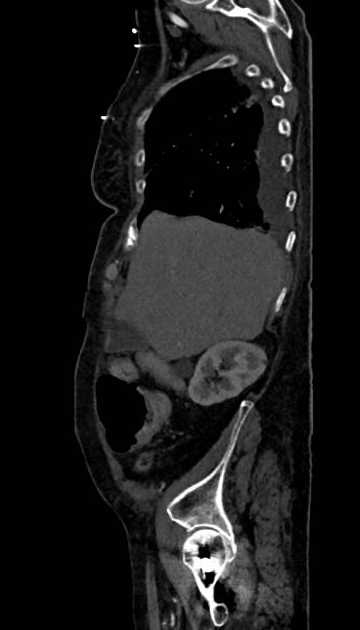 Abdominal aortic aneurysm with thrombus fissuration (Radiopaedia 73192-83919 Sagittal C+ arterial phase 116).jpg